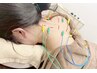 【スマホ首や首こりにお悩みの方】電気美容鍼×全身鍼灸
