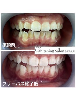 ホワイトニングサロン 京都烏丸店/ホワイトニング施術例