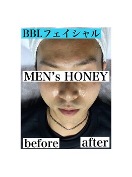 メンズハニー(MEN’s HONEY)/【BBLフェイシャル体験】