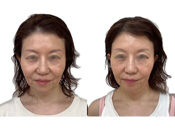 けいのき鍼灸整骨院/美容鍼/ニキビケア/鍼/小顔/毛穴