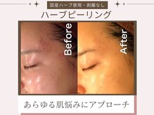 プレステージ 横須賀中央店/ピーリング◆ビフォーアフター