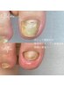 【変形爪再生】（トラブル爪用ネイルオイル代込）
