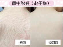 ウルル 金山駅前店(ULULU)/3歳から出来る唯一無二の脱毛