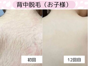 ウルル 金山駅前店(ULULU)/3歳から出来る唯一無二の脱毛