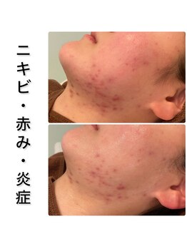 ビオプラス(BioPlus+)/ハーブピーリング/川崎