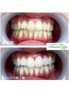 ホワイトニングサロン 名古屋駅店/【ホワイトニング施術例】