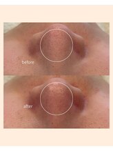 レア(Lea)/黒いポツポツ毛穴も改善＊