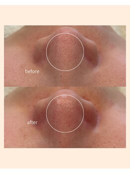 レア(Lea)/黒いポツポツ毛穴も改善＊