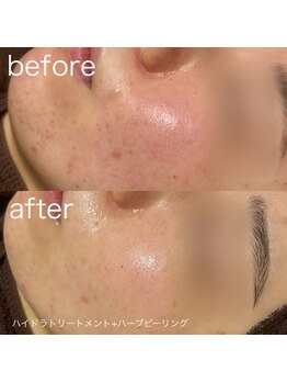 ルルラ リコ(lulula rico)/症例写真/ハーブピーリング