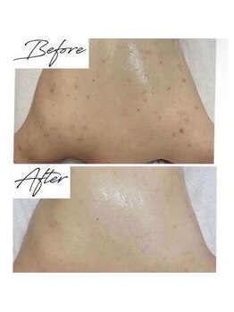 ビズビズ 梅田店(bisebise)/〈症例〉ずっと消えないブツブツ