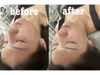 マホロバ(mahoroba)/美容鍼×ララピール