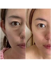 カブール 町田/目の下のクマも解消！バイオセル