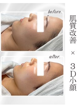 リアム(LiAm)/ララピール×レモンボトル