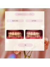 プラスビー 2号店(+b)/ホワイトニングビフォーアフター