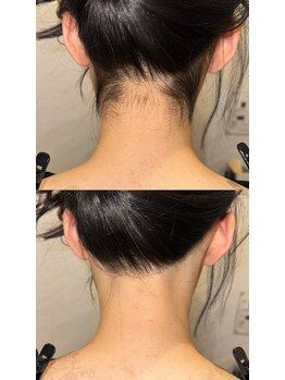 ワイズサロン(Y's salon)/うなじ脱毛