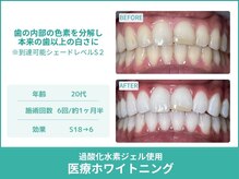 クレア(Crea)/【歯のホワイトニング症例写真】