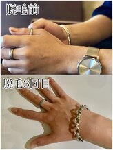 エンチャント(ENCHANT)/メンズ　脱毛施術経過　3回目