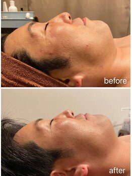 スピード美人 横浜店/顔セル＆ハーブで-5歳！