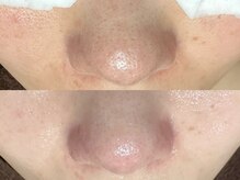 エクラ バイ シャンリィ(eclat by shanLy)/毛穴洗浄