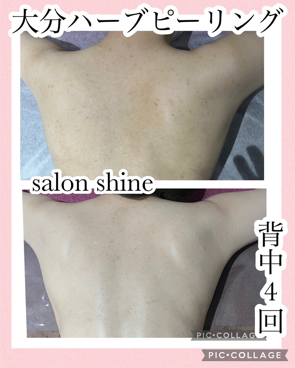 サロンシャイン(Salon Shine)/背中ハーブピーリング４回