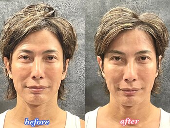 アモーラ(Amora)/エクソソーム導入