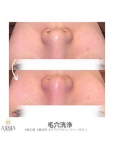アクシア ビューティー サロン(AXSIA)/【毛穴洗浄】BeforeAfter