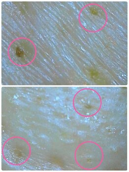 ハーシークレット(Her secret)/ハイドラ毛穴洗浄