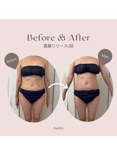 エミル(Emillu)/＊Body_ビフォーアフター