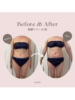 エミル(Emillu)/＊Body_ビフォーアフター