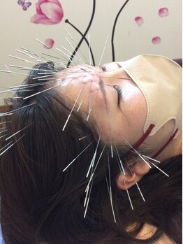 鍼灸施術を受けたい