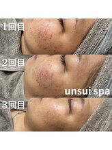 ウンスイスパ(UNSUI SPA)/ニキビケアならララピール