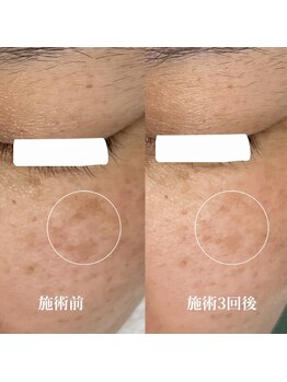 サロンドベルム(Salon de BELME)/シミケア経過:施術3回後