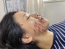 めいてる/美容ばり/リフトアップ/大阪市