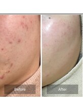 キッカ 梅田天六(Kikka)/ニキビケア＊ハーブピーリング