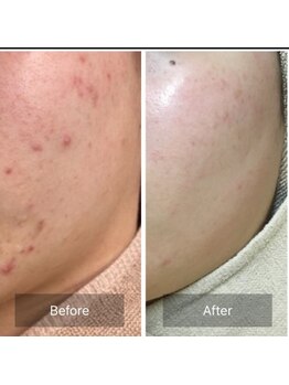 キッカ 梅田天六(Kikka)/ニキビケア＊ハーブピーリング