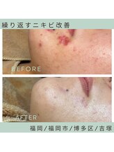 ソワ 吉塚店(soi)/集中して同じ場所にニキビが…