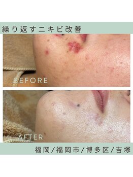 ソワ 吉塚店(soi)/集中して同じ場所にニキビが…