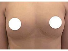 ルミエール(Lumiere)/【倉敷市】バストアップ施術事例