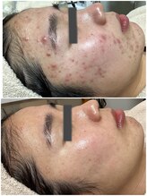 ザ フェース 東京目黒店(THE FAITH)/ニキビケア