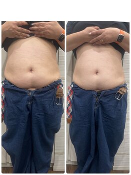 長寿鍼灸院 長寿整骨院/EMS<お腹集中コース>