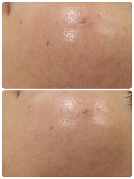 ラピスビリーブ 本店(Lapis believe)/人気の毛穴ケア