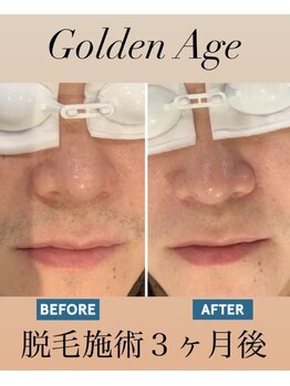 ゴールデンエイジ(Golden Age)/【ヒゲ脱毛】Before&After