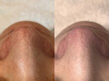 エミナル(Eminal)/◆毛穴フルコース　1回