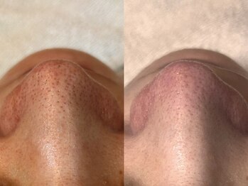 エミナル(Eminal)/◆毛穴フルコース　1回