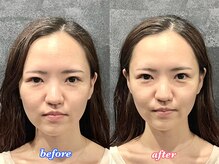 アモーラ(Amora)/エクソソーム導入