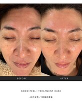 スキンラウンジ(SKIN LOUNGE)/韓国肌管理｜PDRN雪花ピール