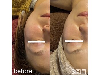 ラニカイ 八代店(Lanikai)/痩身フェイス　30代のお客様