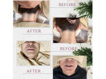 ルミクス脱毛で痛みの少ないスピード脱毛♪最新機種A9X取扱♪