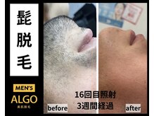 アルゴ 山口店(ALGO)/ひげ脱毛