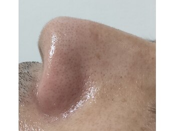 エムスリー(m3)/メンズも毛穴ケア！